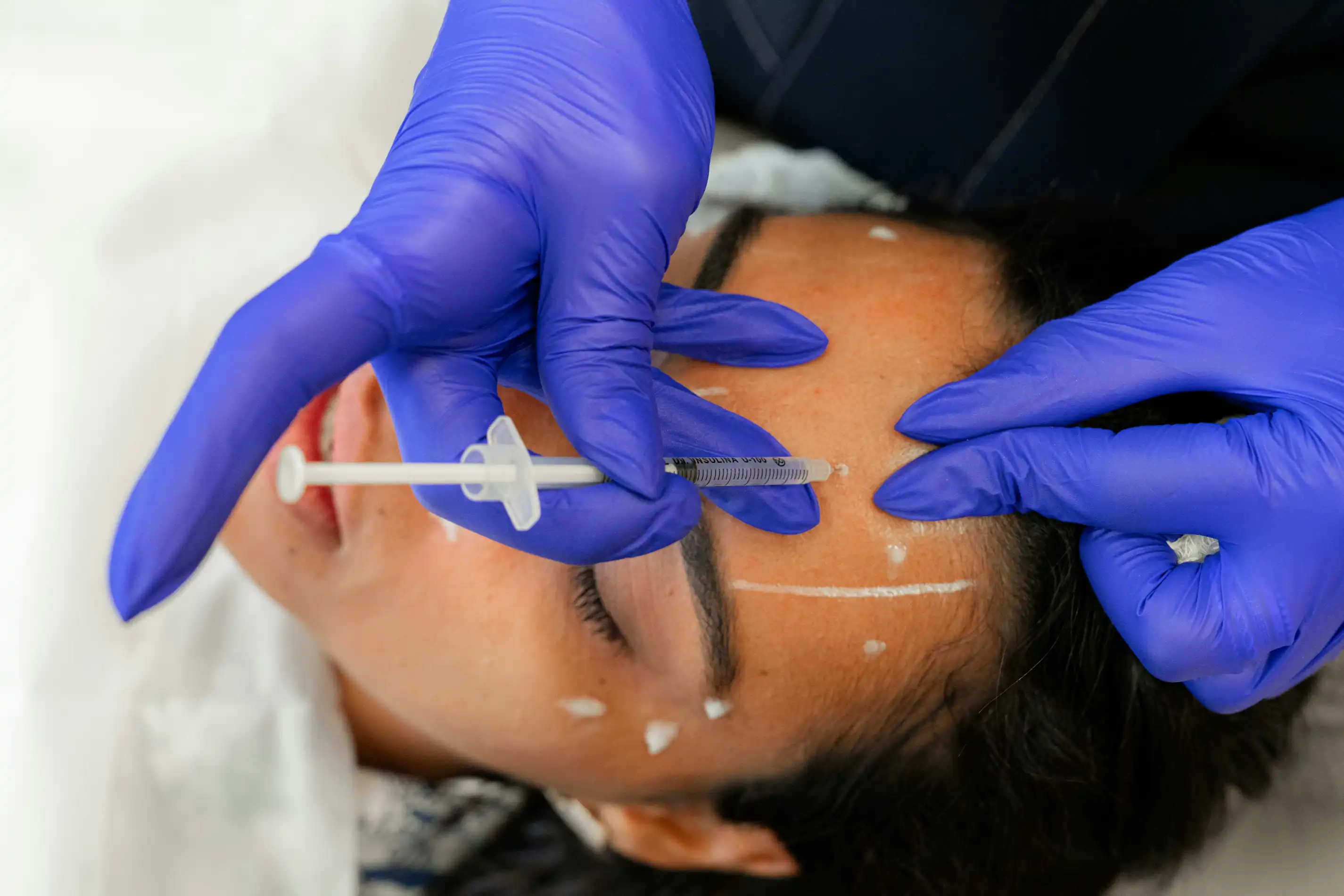 Sculptra-Behandlung World of Aesthetic Prof. Dr. Christian Weinand Hamburg